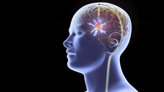 Estimulação Cerebral Profunda na doença de Parkinson